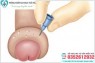 Bao quy đầu bị sưng mọng nước phồng lên như cục mỡ