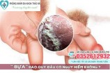 Bao quy đầu có bựa trắng và dương vật xuất hiện mảng trắng
