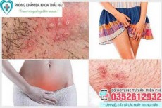 Hình ảnh nổi mụn ở vùng kín nữ giới là bệnh gì, cách chữa