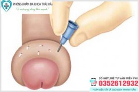 Bao quy đầu bị sưng mọng nước phồng lên như cục mỡ