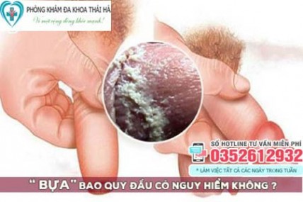 Bao quy đầu có bựa trắng và dương vật xuất hiện mảng trắng