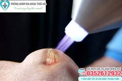 Đốt sùi mào gà: Những lưu ý cần biết khi thực hiện