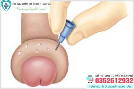 Bao quy đầu bị sưng mọng nước phồng lên như cục mỡ
