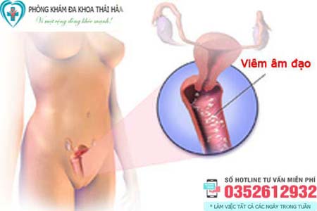 10 Cách chữa viêm âm đạo tại nhà hiệu quả cho nữ giới