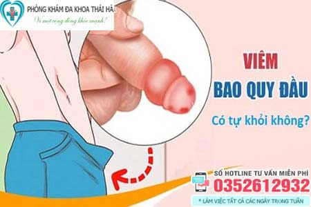 10 Cách chữa viêm bao quy đầu tại nhà ở nam giới